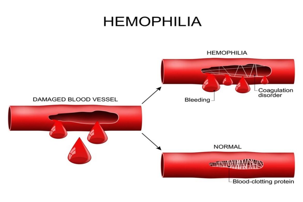 World Haemophilia Day- Letâ€™s know more about this lesser known ...